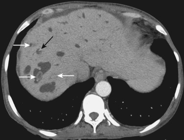 FIG 42-8, Caroli's disease. MDCT shows cystic dilatation of the intrahepatic bile ducts with stones (white arrows). The black arrow indicates the so-called central dot sign.