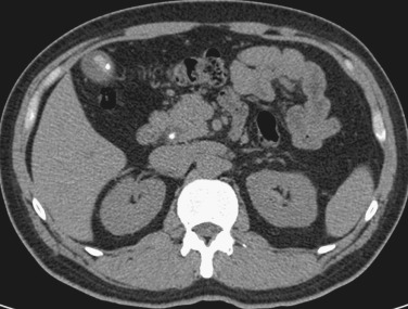 FIG 42-9, Three small stones in the gallbladder and one stone in the common bile duct, which migrated from the gallbladder.