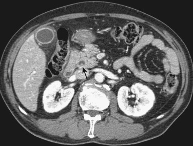 FIG 42-10, A small stone (arrow) in the common bile duct originated in the gallbladder. The wall of the gallbladder is thickened and enhanced, suggesting acute cholecystitis.