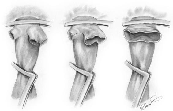 FIGURE 54-1, For outflow reconstruction the anterior wall of the vena cava and three hepatic veins are used to create a large orifice.