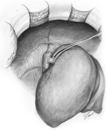 FIGURE 54-2, The phrenic vein originating from the inferior vena cava is ligated and divided to secure a wider space to cross-clamp the suprahepatic vena cava.