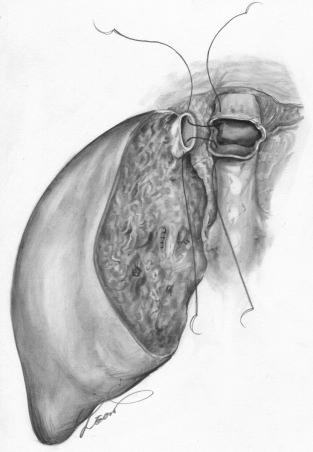 FIGURE 54-3, Both ends of the posterior wall of the graft right hepatic vein are sutured to those of the recipient vein. This is the first maneuver in hepatic vein reconstruction, which is important to determining the correct “axis” of the outflow route.