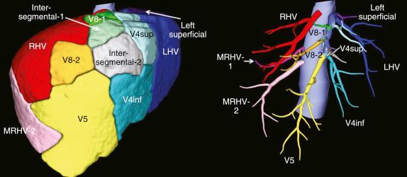 FIGURE 54-4, Analysis of the region (left) to which each vein drains and the vein anatomy (right) . The volume of each area is calculated. inf , Inferior; LHV , left hepatic vein; MRHV , middle right hepatic vein; RHV , right hepatic vein; sup , superior.