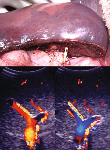 FIGURE 54-5, The congestive area can be seen intraoperatively after transection of the parenchyma by temporal clamping of the right hepatic artery (top) . After the right hepatic artery is clamped, the liver surface in the right anterior segment turns dark red. Also, intraoperative Doppler ultrasonography is performed (bottom left) . If the portal flow of the anterior segment is hepatofugal (bottom right) , the area is congested.