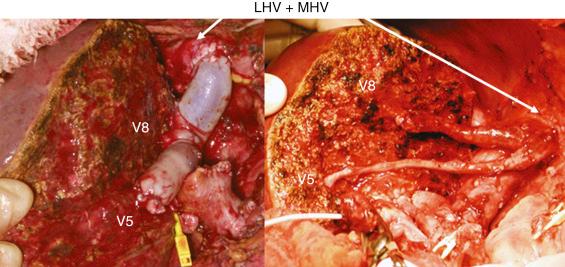 FIGURE 54-6, The tributaries of the middle hepatic vein can be reconstructed using vein grafts, either cryopreserved homografts (left) or autografts (right) . LHV+MHV , Orifices of left and middle hepatic veins of the recipient; V5 , orifice of middle hepatic vein tributary of segment V; V8 , orifice of middle hepatic vein tributary of segment VIII.