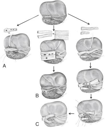 FIGURE 54-7, A, When multiple short hepatic veins exist in the right liver graft, a cryopreserved inferior vena cava (IVC) graft is used for outflow reconstruction. The homograft is anastomosed side to side with the recipient vena cava. B, When an IVC graft is not available, a femoral vein graft may be used. In this technique the femoral vein graft is folded and placed on the IVC sulcus of the graft. C, This is another technique. A thinner vein graft is unified into one sheet and used as an alternative for an IVC graft.