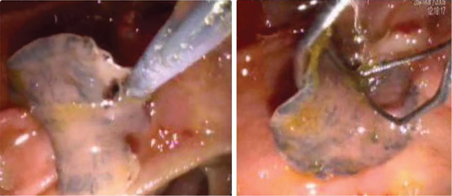 FIGURE 45.4, Adults of Fasciola hepatica observed with endoscopic retrograde cholangiopancreatography (ERCP) imaging.