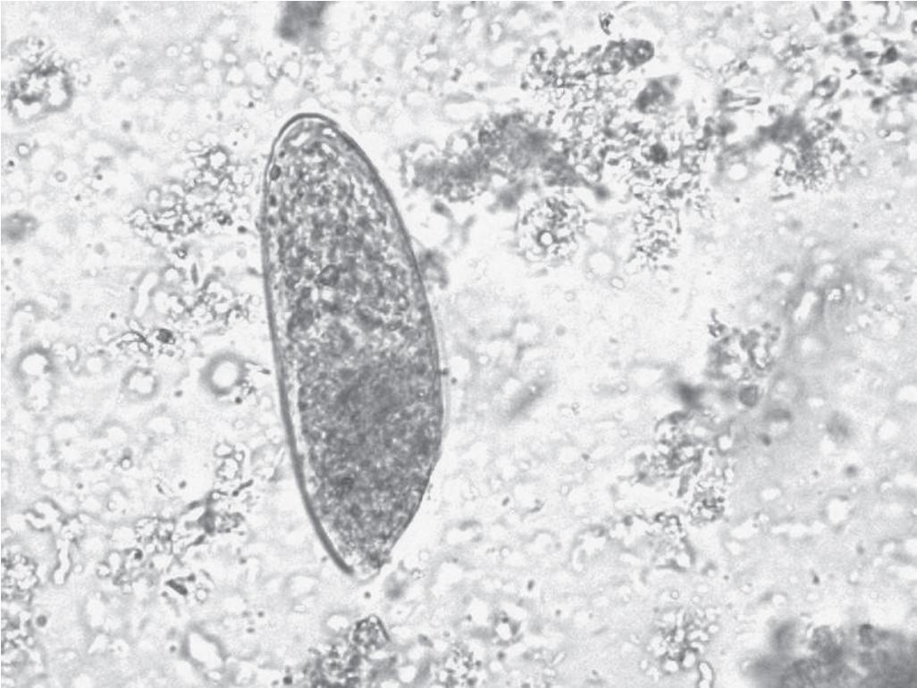 FIGURE 45.5, Adult egg of Fasciola hepatica in microscopic examination of stools by the rapid sedimentation technique.