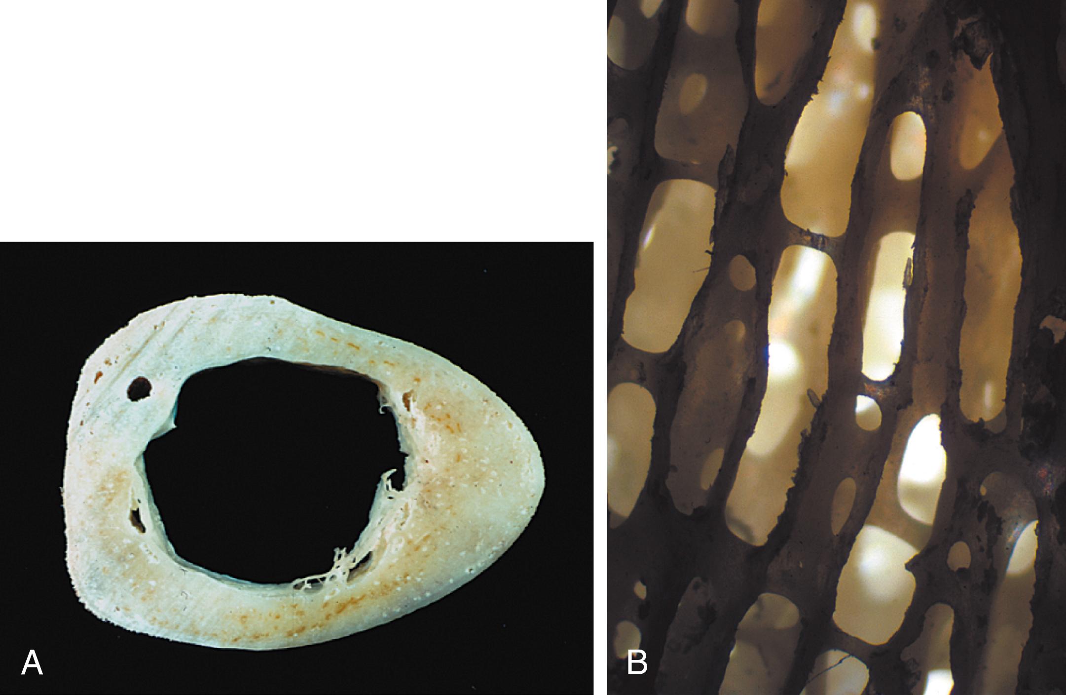 Figure 16.1, A, Compact bone, long bone, cross-section. The compact bone of the cortex of the femur in this 30-year-old male is continuous and solid, and the vascular spaces are not grossly visible. The hollow medullary cavity is filled with fatty marrow in vivo. B, Cancellous bone, longitudinal section. The cancellous bone is arranged in highly perforated vertical plates interconnected by delicate horizontal struts (braces). Most of its volume appears to be empty space once the marrow has been removed.