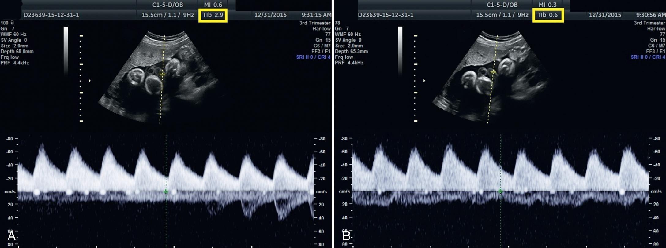 FIG. 29.1, Effect of Changing Power Setting on Thermal Index of Bone (TIB) During Spectral Doppler Velocity Measurements of Umbilical Artery.