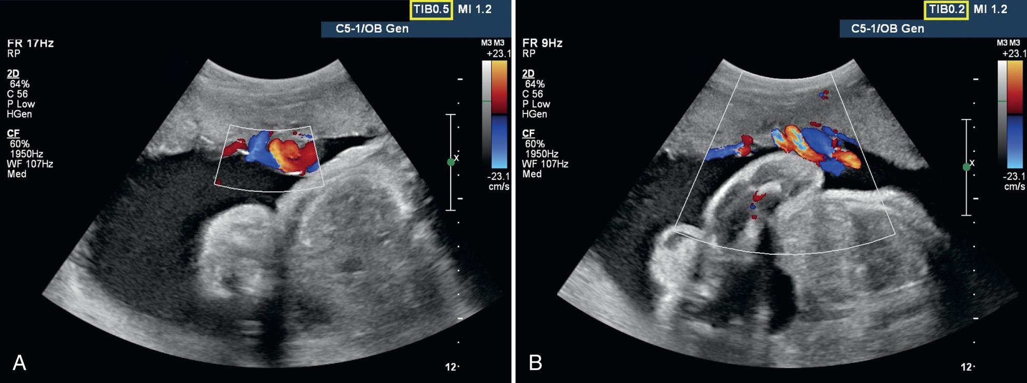 FIG. 29.3, Effect of Changing Size of Color Box on Thermal Index of Bone (TIB) During Color Doppler Examination of Umbilical Cord.