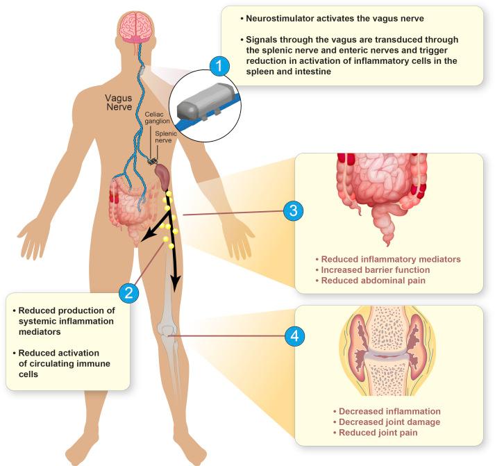 Figure 127.1, Neurostimulation of the cholinergic antiinflammatory pathway with an implantable medical device: A potential alterative therapeutic approach for rheumatoid arthritis and inflammatory bowel disease.