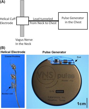 Figure 127.2, The vagus nerve stimulation system used in proof-of-concept studies.