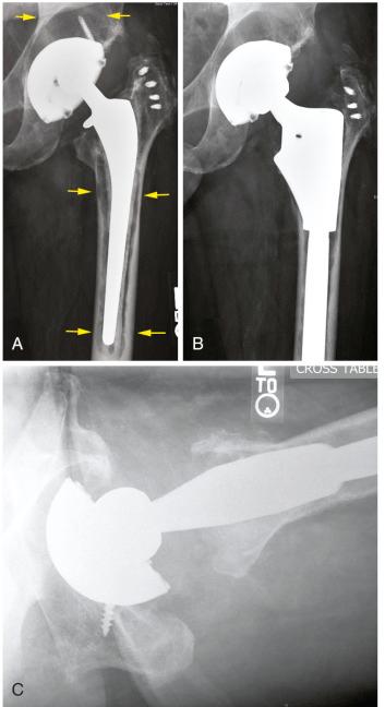 Fig. 8.1, Total hip replacement with polyethylene wear, acetabular osteolysis, and loosening and osteolysis around the cemented femoral component. (A) Preoperative radiograph. The upper arrows point to the acetabular osteolysis. Note the eccentrically positioned femoral head indicating wear of the plastic. The cemented femoral component is loose, and the prosthesis has subsided within the bone. The cement mantle has fragmented. Cement debris has led to scalloping of the surrounding bone (lower arrows). Postoperative anteroposterior (B) and lateral (C) radiographs of the revised hip replacement. The osteolytic areas in the acetabulum were bone grafted, and the acetabular plastic liner and femoral component were changed.