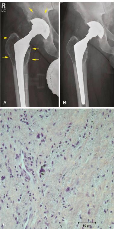 Fig. 8.2, Total hip replacement with polyethylene wear and osteolysis. (A) This metal-on-polyethylene cementless total hip replacement demonstrates eccentricity of the head within the polyethylene liner, indicating substantial wear of the plastic. Extensive osteolysis is seen around the metal socket and in the proximal femur (arrows) . (B) Postoperative radiograph after polyethylene liner and femoral head exchange. The osteolytic lesions were debrided and then filled with bone graft. The acetabular shell and the femoral component were well fixed and in satisfactory position. (C) Photomicrograph of histologic section from tissue retrieved from granulomatous synovial capsular tissues demonstrates sheets of macrophages in a fibrovascular stroma. Abundant granular white specks of polyethylene and black metal particles are seen (hematoxylin and eosin stain, polarized light, ×40 magnification).