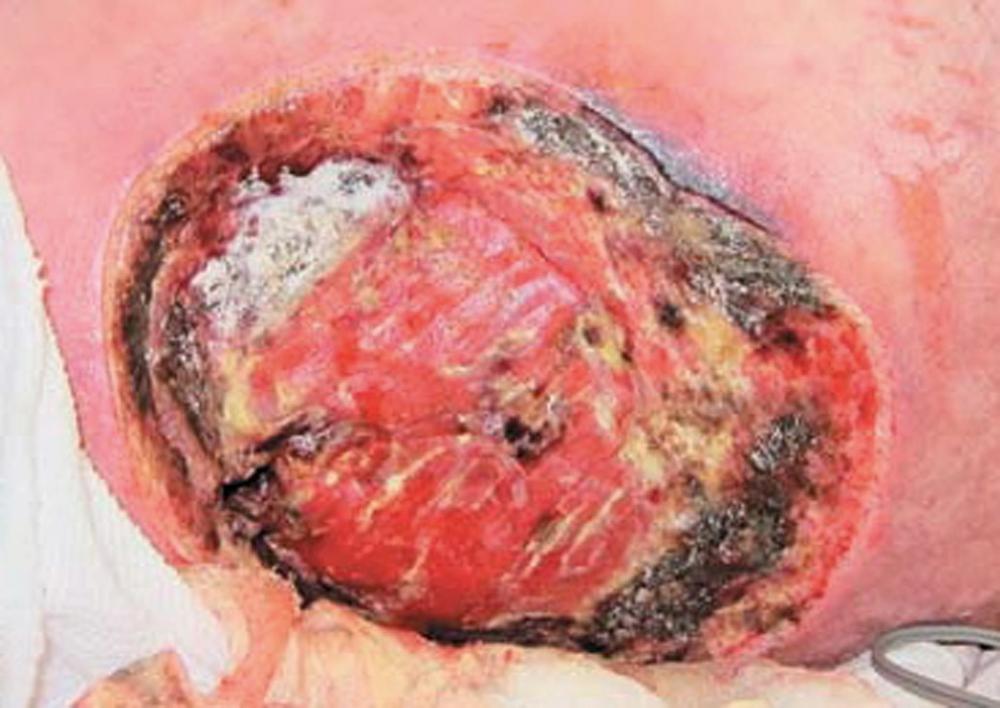 Fig. 68.4, Necrotizing cutaneous mucormycosis of the flank following the Joplin, MO tornado.
