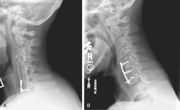 FIGURE 48-1, A, This patient underwent C5-C7 corpectomy with fibular allograft and plate. Flowing bone and remodeling can be seen. B, This patient underwent a two-level anterior cervical diskectomy and fusion at C5 to C7. The C5-C6 level demonstrates solid fusion with bridging bone; however, the lower level demonstrates clear nonunion. Radiolucencies around the graft and broken screws are visible.