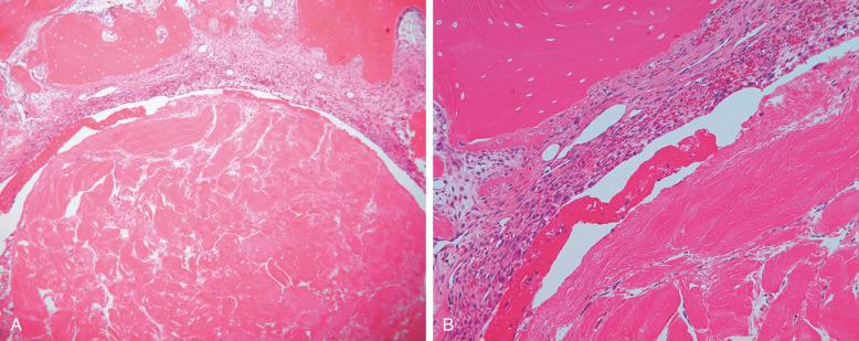 FIG 5-2, Insertion site histology 1 to 2 weeks after anterior cruciate ligament reconstruction. Shown are low-power (A) and high-power magnification (B) . Vascular, highly cellular granulation tissue is interposed as a layer between the graft and tunnel wall.