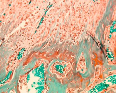 FIG 5-3, Insertion site histology 3 to 4 weeks after anterior cruciate ligament reconstruction. The interposed tissue has matured with oriented, Sharpey-like collagen fibers bridging the tendon to bone.