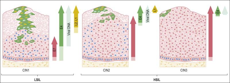 Figure 9.5, HPV early and late gene expression from initial HPV infection through maturation, from CIN 1–3, by evolutionary HPV type. The productive cycle begins close to the basal layer and viral genome amplification begins in the parabasal cell layers.