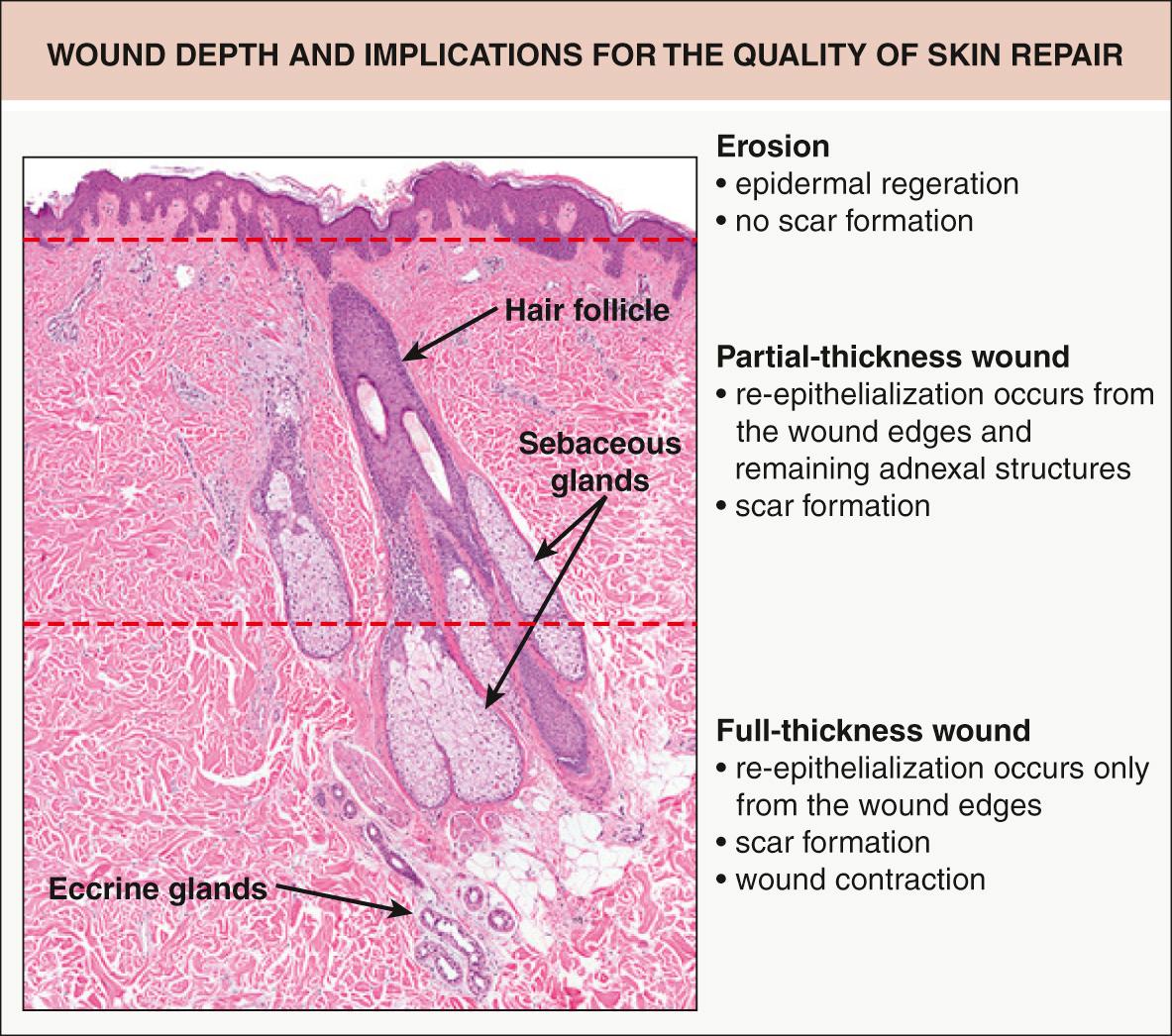 Fig. 141.2, Wound depth and implications for the quality of skin repair.