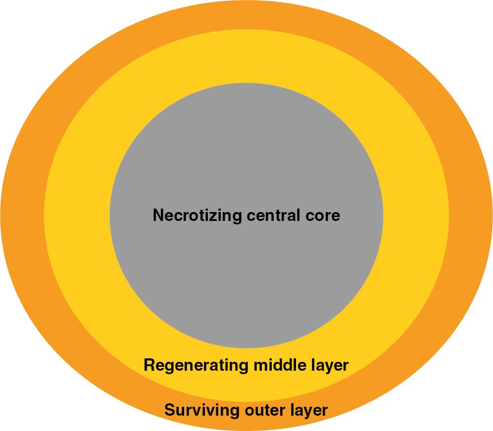 Fig. 14.2, Representative scheme of the layers found within a fat particle: surviving outer layer, regenerating middle layer, necrotizing central core.