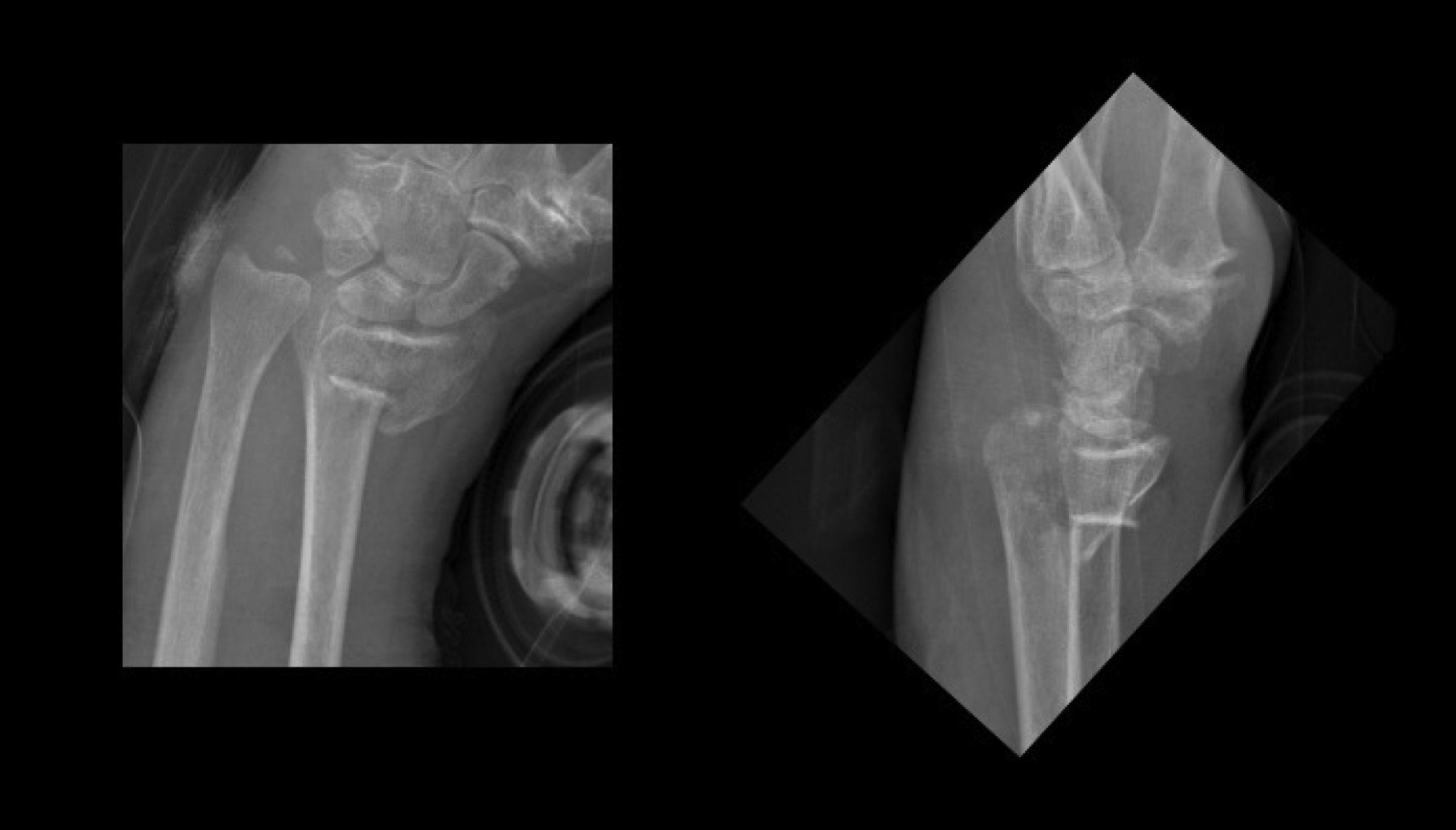 Fig. 1, Open comminuted articular DRF.