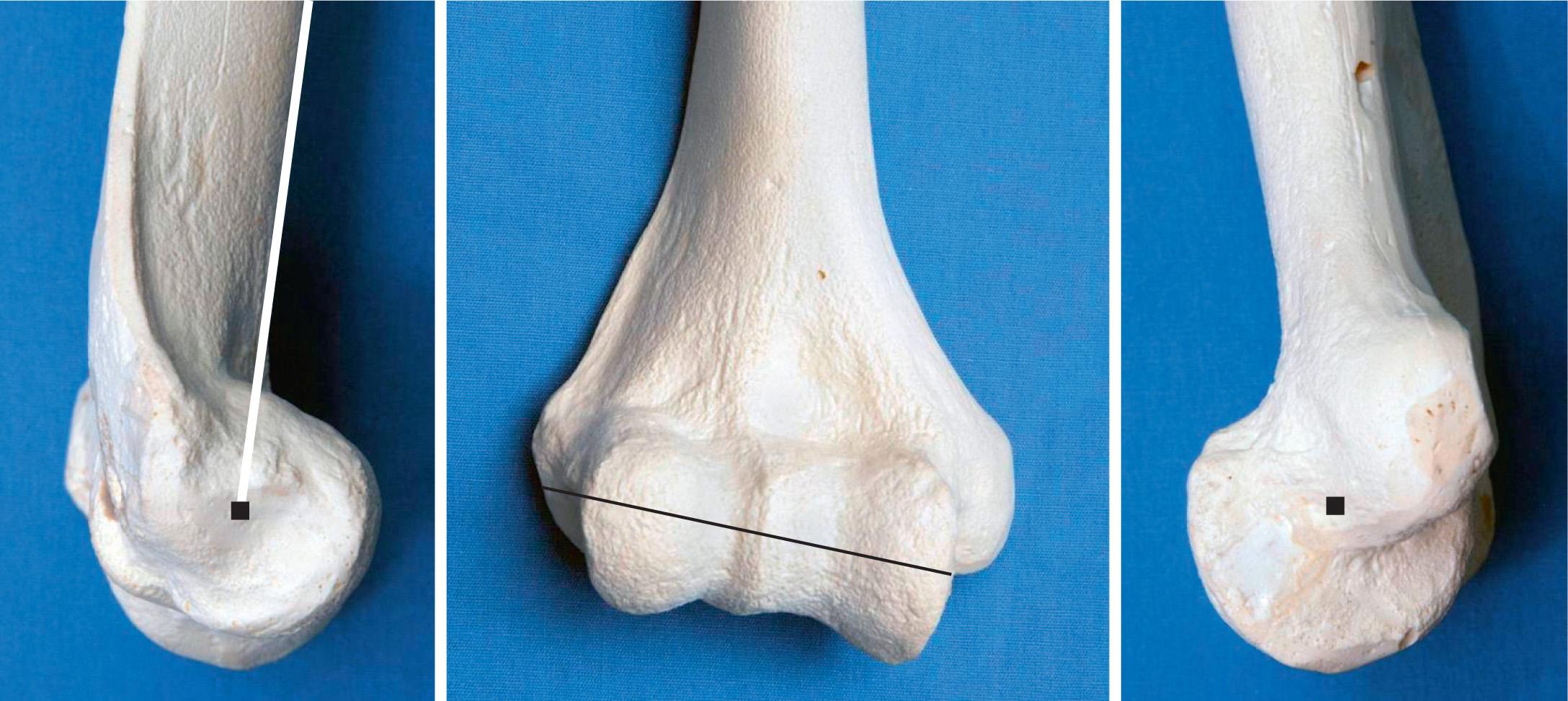 FIG 86.1, Very small locus of instant center of rotation for the elbow joint may be replicated by a single line drawn from the inferior aspect of the medial epicondyle through the center of the lateral epicondyle, which is in the center of the lateral projected curvature of the trochlea and capitellum.