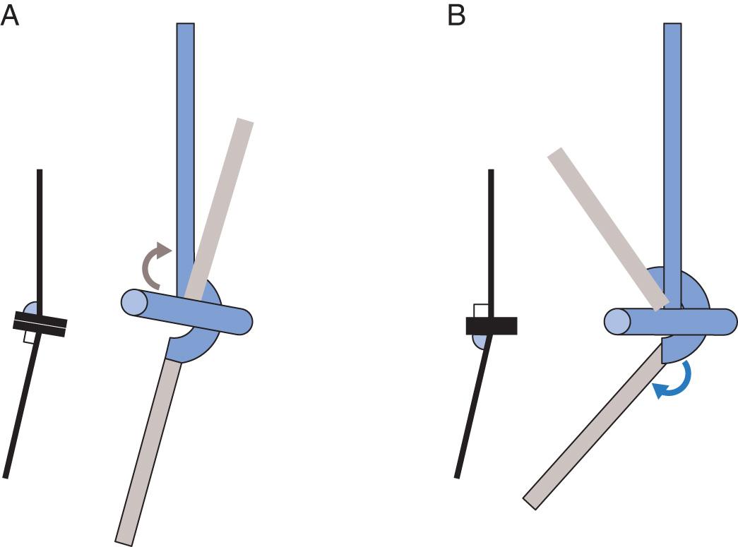 FIG 86.2, The carrying angle is defined by the combination of humeral and ulnar articulation tilt. Dominance of the (A) humeral or (B) ulnar angle affects the kinematics, especially carrying angle change with flexion.