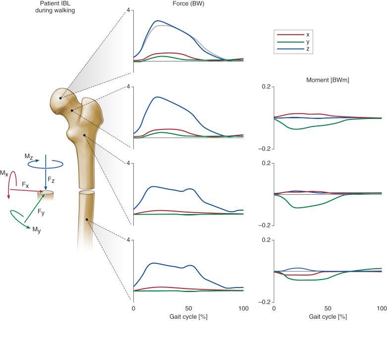 Fig. 2.2, Internal loads at 4 levels of the femur during the walking cycle are shown for one specific subject. Forces are given in multiples of body weight (BW), moments in body weight meters (BWm), and time in the percent of the walking cycle, starting with heel strike. Dark graphs: F x is the shear force from medial to lateral; F y is the shear force from anterior to posterior; and F x is the axial compression force from proximal to distal. M x is the backward acting bending moment in the sagittal plane; M y is the inward acting bending moment in the frontal plane; and M z is the torsional moment in the transverse plane. The moments at the head center are zero. Light graph: In vivo measured hip contact force component is F z . All signs are reversed for the proximal sides.