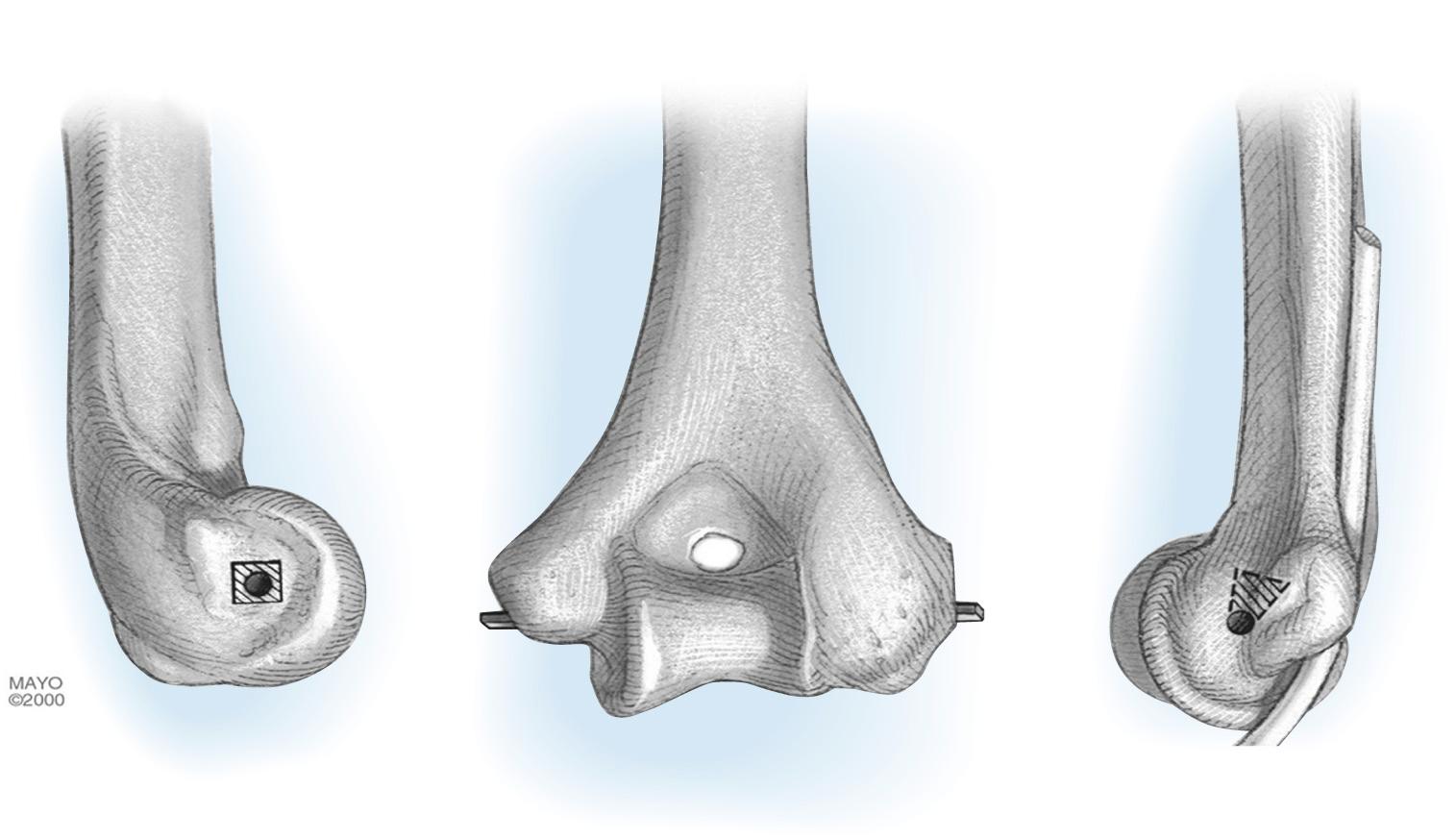 FIG 3.1, Configuration and dimensions of the locus of the instant center of rotation of the elbow. This axis runs through the center of the articular surface, as viewed on the anteroposterior and lateral planes.