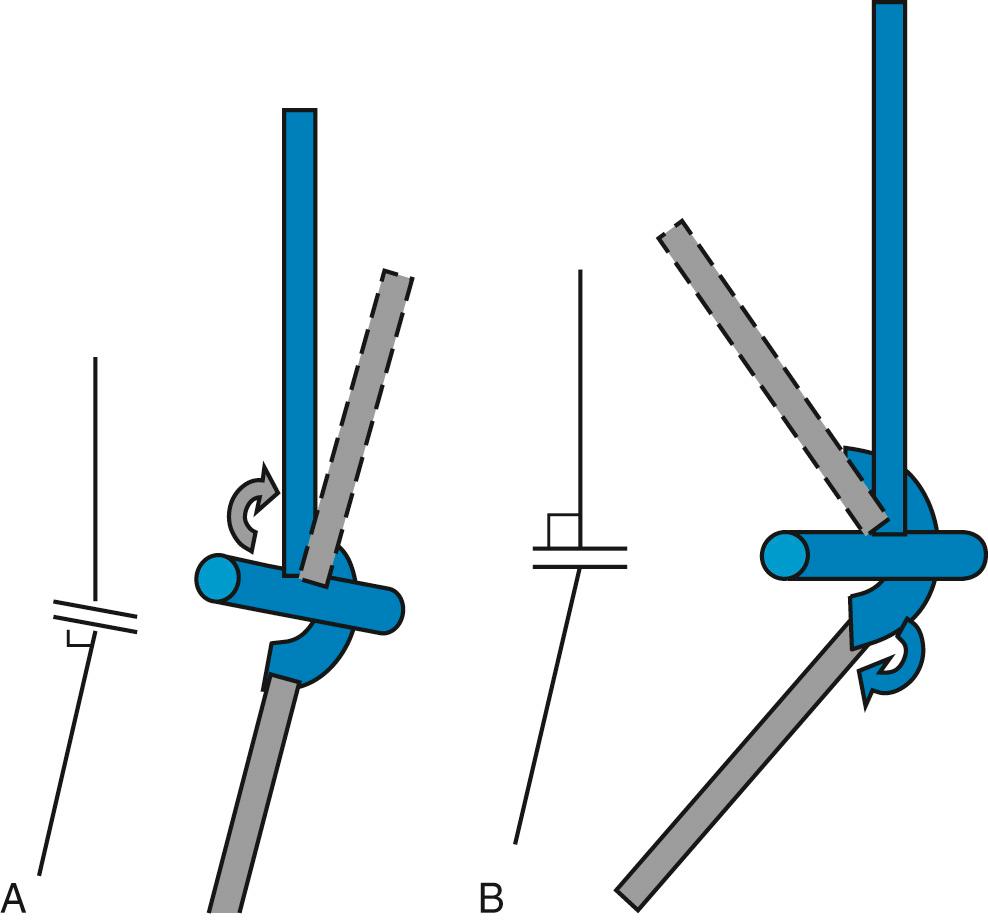 FIG 3.3, The positional relationship of the forearm referable to the humerus in the frontal plane of the humerus (carrying angle) is dependent on the relative tilt of the humeral and ulnar articulations referable to their long axes.