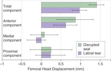 Fig. 1.4, Change in displacement of the femoral head within the acetabulum when loaded with an abduction moment in 20 degrees of external rotation for hip joints tested with the labrum intact, then vented, then torn.