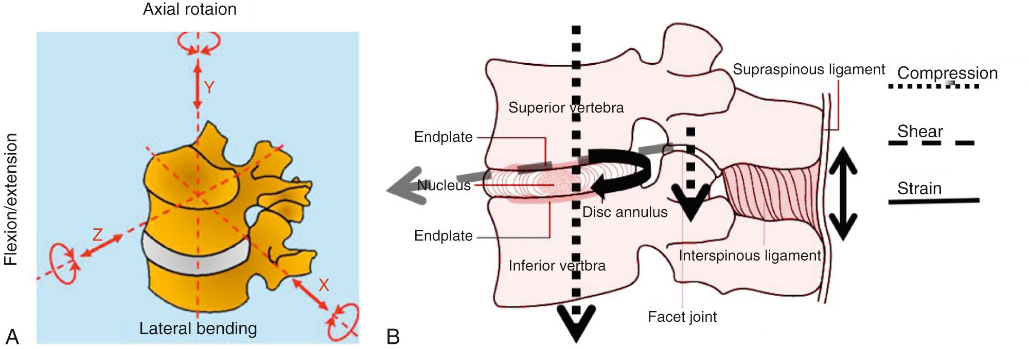 Figure 5.1, (A) The functional spinal unit (FSU) rotates around three cardinal axes: the X-axis creating sagittal flexion and extension, the Y-axis creating axial rotation, and the Z-axis creating lateral bending. Coupling of these movements allows multidirectional motion of the trunk in three dimensions. (B) Anteriorly vertebral bodies articulate with a fibrocartilaginous intervertebral disc and posteriorly with two facets. Trunk movements produce compressive loading forces directed axially through the three-joint complex, strain forces stretching the elastic fibers within connective tissue, and shear forces directed horizontally at the interface of articulating surfaces.