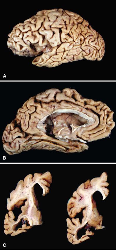 Fig. 27.1, Gross appearance of brain with Alzheimer disease (AD). Marked generalized cortical atrophy (gyral thinning and sulcal widening) is noted on gross inspection of the postmortem left hemibrain from a patient with advanced AD (A, lateral view; B, medial view ) (most of the arachnoid membrane was removed to reveal the cortical surfaces). On coronal sections, there is also marked hippocampal atrophy and hydrocephalus ex vacuo (C).