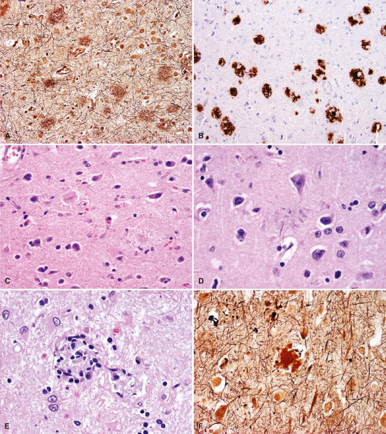 Fig. 27.2, Plaques of β-amyloid peptide deposition in normal aging and Alzheimer disease. Diffuse plaques are patchy deposits of β-amyloid peptides (predominantly Aβ 42 ) in neuropil, best observed with Bielschowsky silver stain (A) and amyloid precursor protein (APP) immunohistochemistry (B). Neuritic plaques (NPs) are detected on H & E stain as spherical eosinophilic structures with (C) or without (D, note associated dystrophic neurites) amyloid cores. When associated with many microglia, NP may rarely be cellular enough to mimic small granulomas (E). Sometimes β-amyloid peptides aggregate as “burned-out” cores (F, Bielschowsky) without associated argyrophilic, tau-immunoreactive dystrophic neurites, or reactive glia, which may be difficult to distinguish from the amyloid plaques seen in prion diseases.