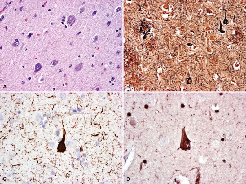 Fig. 27.3, Neurofibrillary tangles (NFTs) in normal aging and Alzheimer disease. On H & E stain, NFTs in neocortical neurons appear as pale basophilic fibrillary cytoplasmic inclusions in cell bodies (A). On Bielschowsky silver stain, neocortical NFTs are dense black fibrillary cytoplasmic inclusions shaped according to the neuronal cell bodies in which they are formed (B, note accompanying neuritic plaques and wavy neuropil threads). NFTs can also be demonstrated by immunohistochemistry using antibodies against hyperphosphorylated tau (C) and ubiquitin (D).