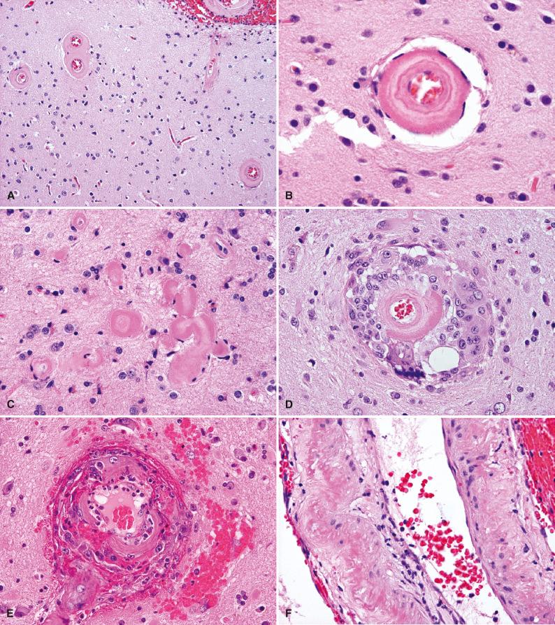 Fig. 27.4, Cerebral amyloid angiopathy (CAA). Deposition of β-amyloid peptides (predominantly Aβ 40 ) stiffens the wall of leptomeningeal and cortical vessels and renders the affected small arterioles as rounded cross-sectional profiles with replacement of smooth muscle cells by eosinophilic and homogeneous material on hematoxylin and eosin stain (A). Sometimes vessels affected by CAA show the fibrillary amyloid deposits in concentric layers (B). Cortical capillaries entirely impregnated with β-amyloid peptides may lose their lumen and endothelial cells altogether, so-called dyshoric angiopathy (C). Occasionally, vessels affected by CAA have associated multinucleated giant cells and mitotically active microglia (D) that appear to be effective in clearing some of the Aβ 40 deposits. At times, these abnormal vessels show associated neutrophils, luminal stenosis, and extravasation, so called amyloid-beta–related angiitis (E). They should not be confused with primary CNS vasculitis or meningeal carcinomatosis. Larger meningeal vessels affected by CAA may contain vacuoles or irregular spaces (presumably left by degenerating smooth muscle cells) in addition to eosinophilic amyloid deposits in their walls (F).