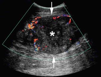 eFIGURE 117-1, Doppler ultrasound study of a soft tissue mass (arrows) in the thigh shows peripheral tumor vessels demarcating areas of viable tissue. The central hypovascular region (asterisk) would not be a good target for biopsy because of the possibility of necrosis. Biopsy of peripheral tissue in the vicinity of the vessels was diagnostic for malignant fibrous histiocytoma.