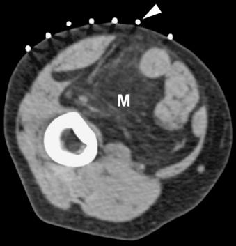 eFIGURE 117-2, A pre-biopsy CT through a low-grade liposarcoma (M) in the posterior compartment of the mid thigh, with a radiopaque biopsy grid in place, helps localize the most suspicious portion of the mass for biopsy (deep to the arrowhead).