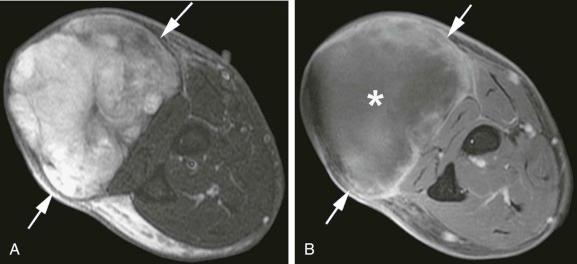 eFIGURE 117-3, Axial T2-weighted, fat-suppressed ( A ) and gadolinium-enhanced, T1-weighted, fat-suppressed ( B ) MR images through a high-grade pleomorphic sarcoma (arrows) in the forearm. The T2-weighted image in A shows heterogeneous high signal intensity within the mass. The enhanced T1-weighted image in B more clearly defines the peripheral location of viable tumor and the large central area of necrosis (asterisk).