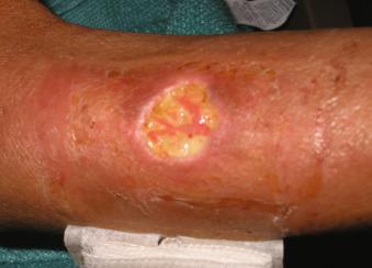 Figure 3.1, Forearm lesion in renal transplant recipient at site of prior intravenous catheter. Swab cultures grew methicillin-susceptible Staphylococcus aureus . The lesion failed to heal after multiple courses of antibacterial therapy. Biopsy revealed Cryptococcus neoformans . Healing occurred on antifungal therapy.