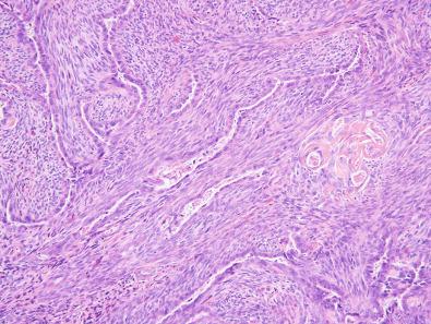 Figure 9.1, Biphasic Synovial Sarcoma.