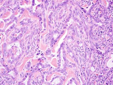 Figure 9.3, Biphasic Synovial Sarcoma.