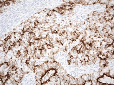 Figure 9.4, Biphasic Synovial Sarcoma.