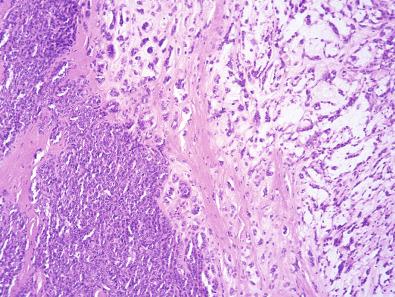 Figure 9.6, Soft Tissue Myoepithelioma.