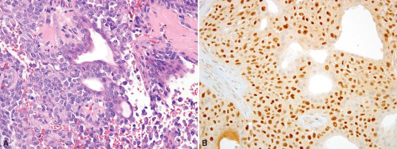 Figure 9.8, Soft Tissue Myoepithelioma.