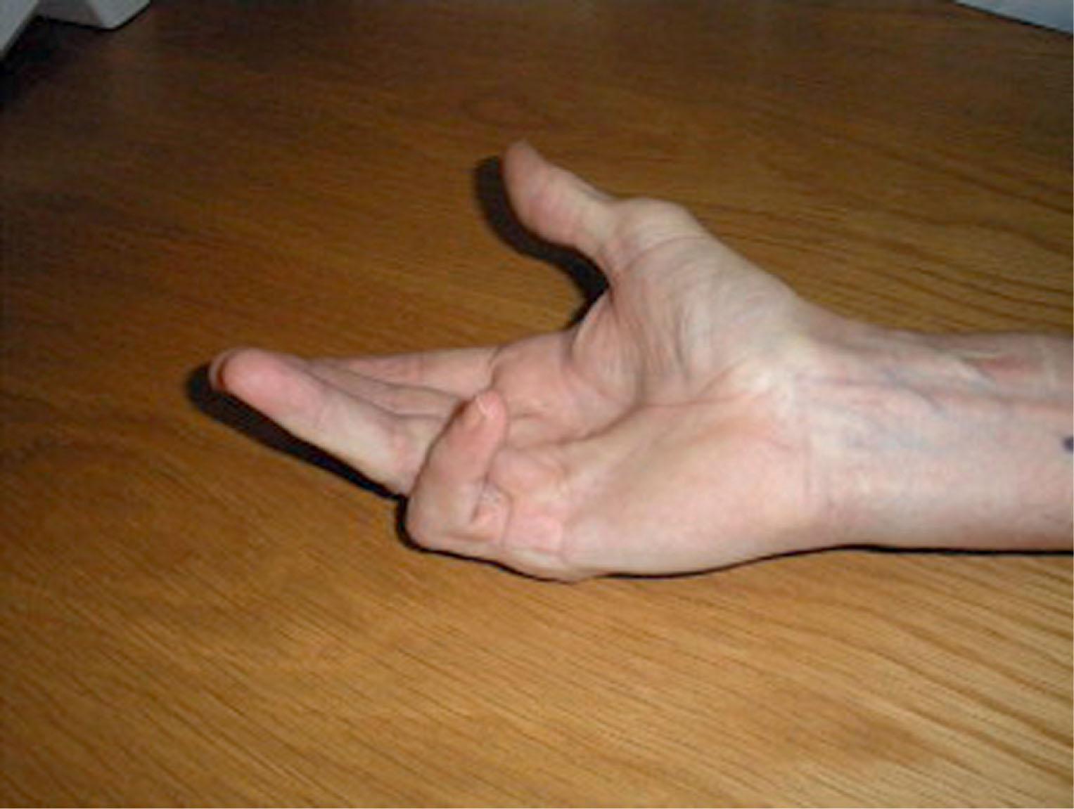 Fig. 12.1, This clinical photograph demonstrates the classic presentation of Dupuytren disease. The ulnar fingers show flexion contractures.