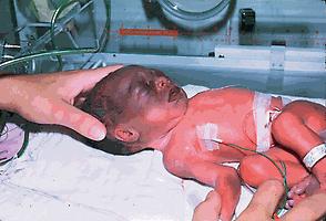 Fig. 29.1, Marked bruising of entire face of a 1490-g female infant born vaginally after face presentation. Less severe ecchymoses were present on extremities. Despite use of phototherapy from the first day, icterus was noted on the third day, and exchange transfusions were required on the fifth and sixth days.