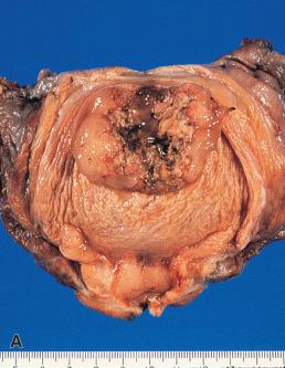 Figure 25.1, Gross Appearance of Adenocarcinoma Arising From Urachal Remnants.